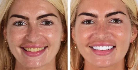 Dentifrice blanchissant probiotique Gestion de la santé bucco-dentaire(Élimine des années de taches)