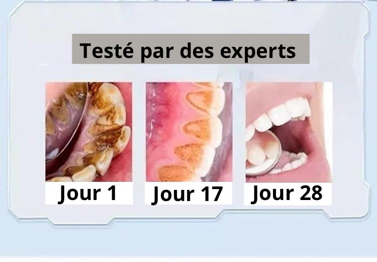 Dentifrice blanchissant probiotique Gestion de la santé bucco-dentaire(Élimine des années de taches)