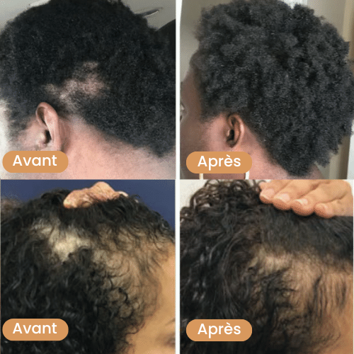 Huile naturelle pour la croissance des cheveux