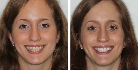 Dentifrice blanchissant probiotique Gestion de la santé bucco-dentaire(Élimine des années de taches)